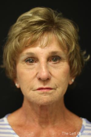 Facelift: Patient 4 - After Image 1