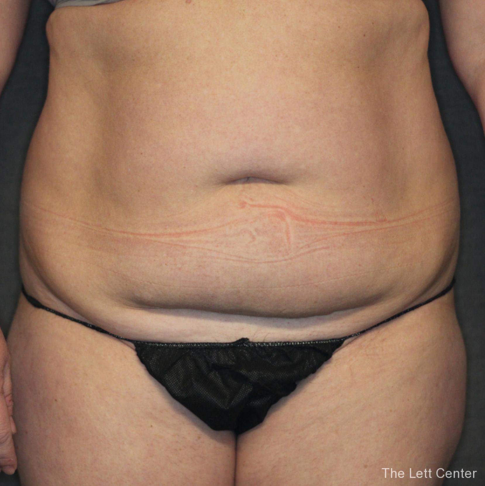 Abdominal Liposuction Results | Before After Gallery - Before 1