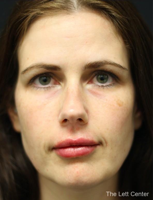 Lip Fillers in Mt. Juliet & Lebanon, TN - After