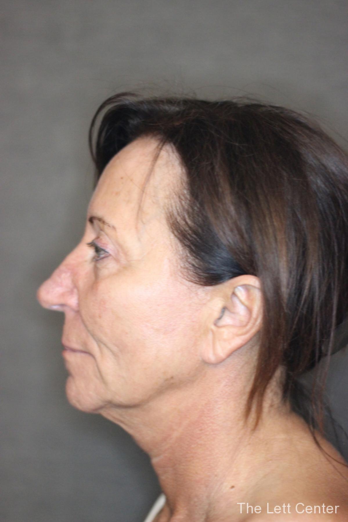 Results from Patient 2 from Facelift Surgery at The Lett Center - Before 2