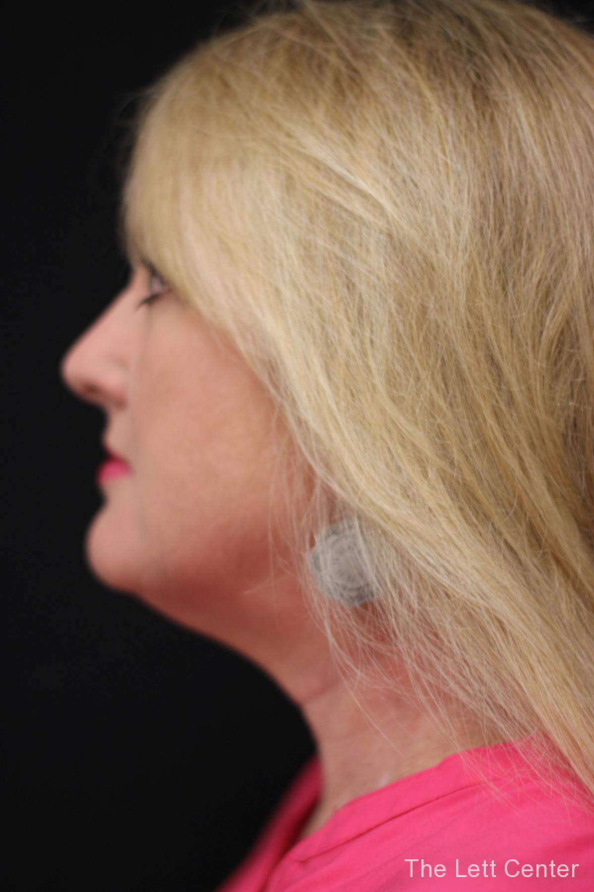 FaceTite treatments at The Lett Center in Lebanon, TN -  After 2