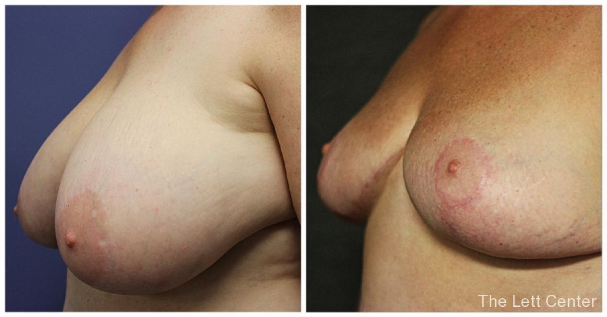 breast reduction with plastic surgeon dr lett at the lett center in lebanon - Before and After 1