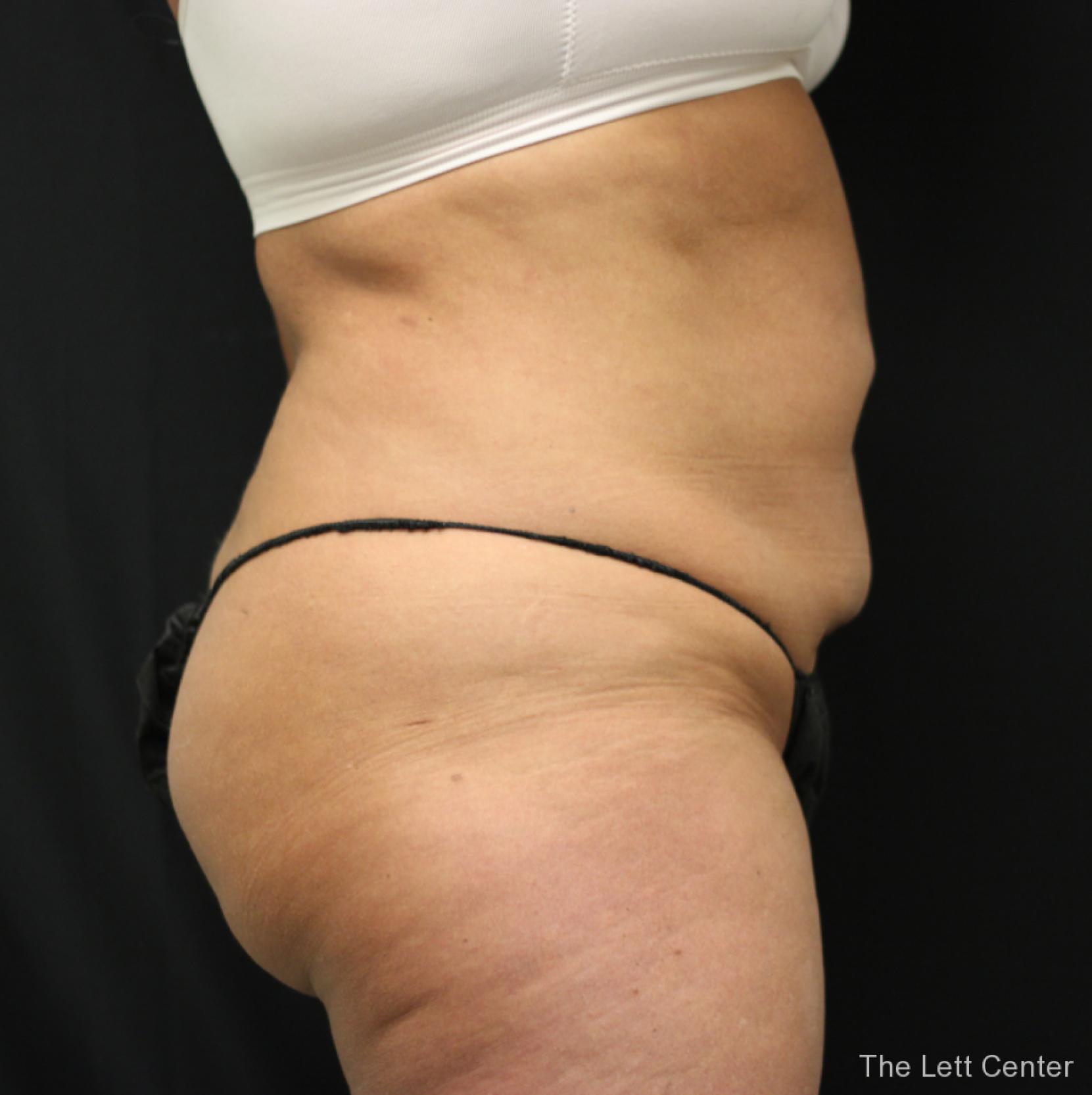 Abdominal Liposuction Results | Before After Gallery - After 3