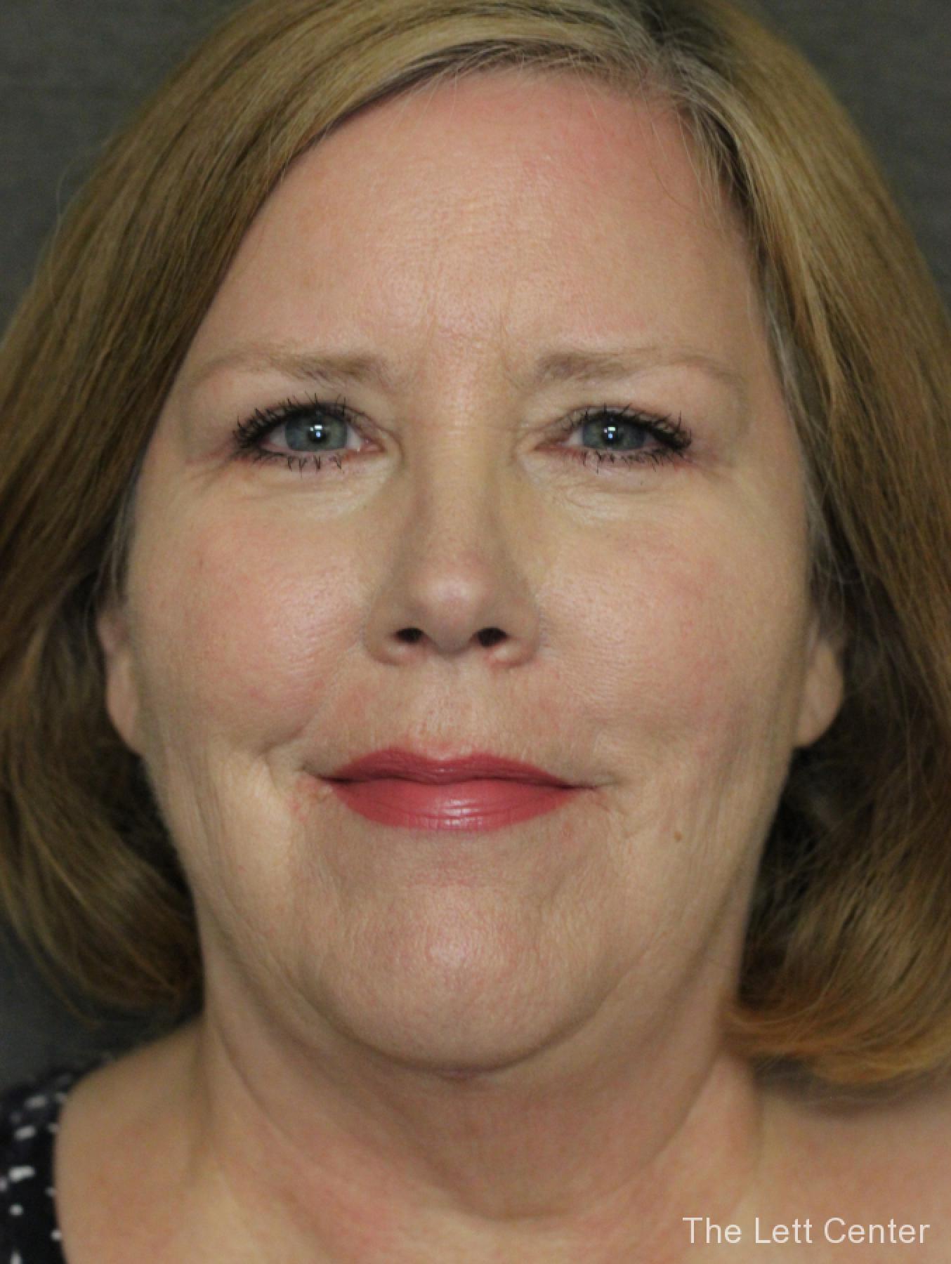 See the results from blepharoplasty or eyelid surgery - After 4