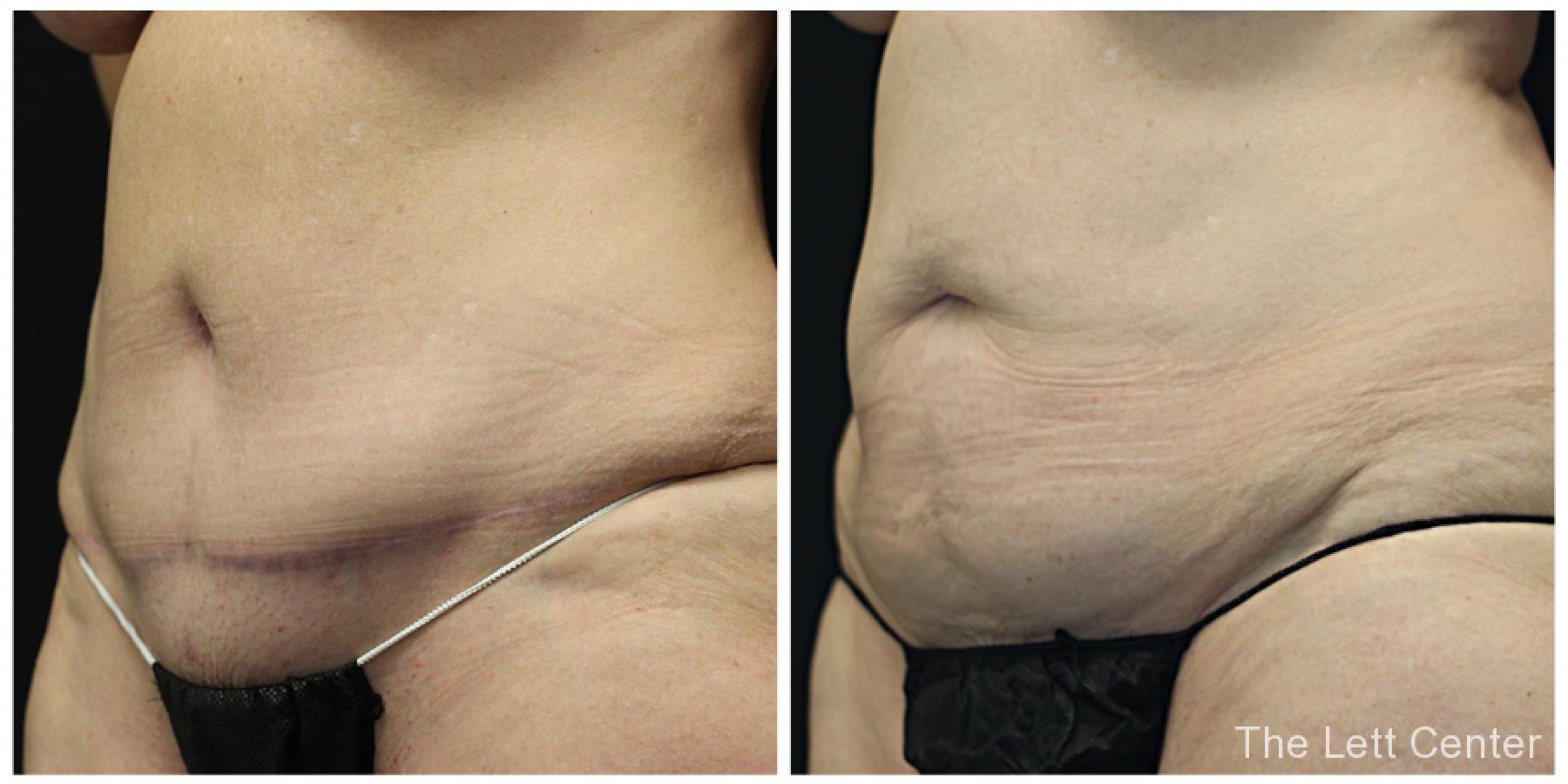 Abdominoplasty before and after results at the Lett Center - Before and After 2