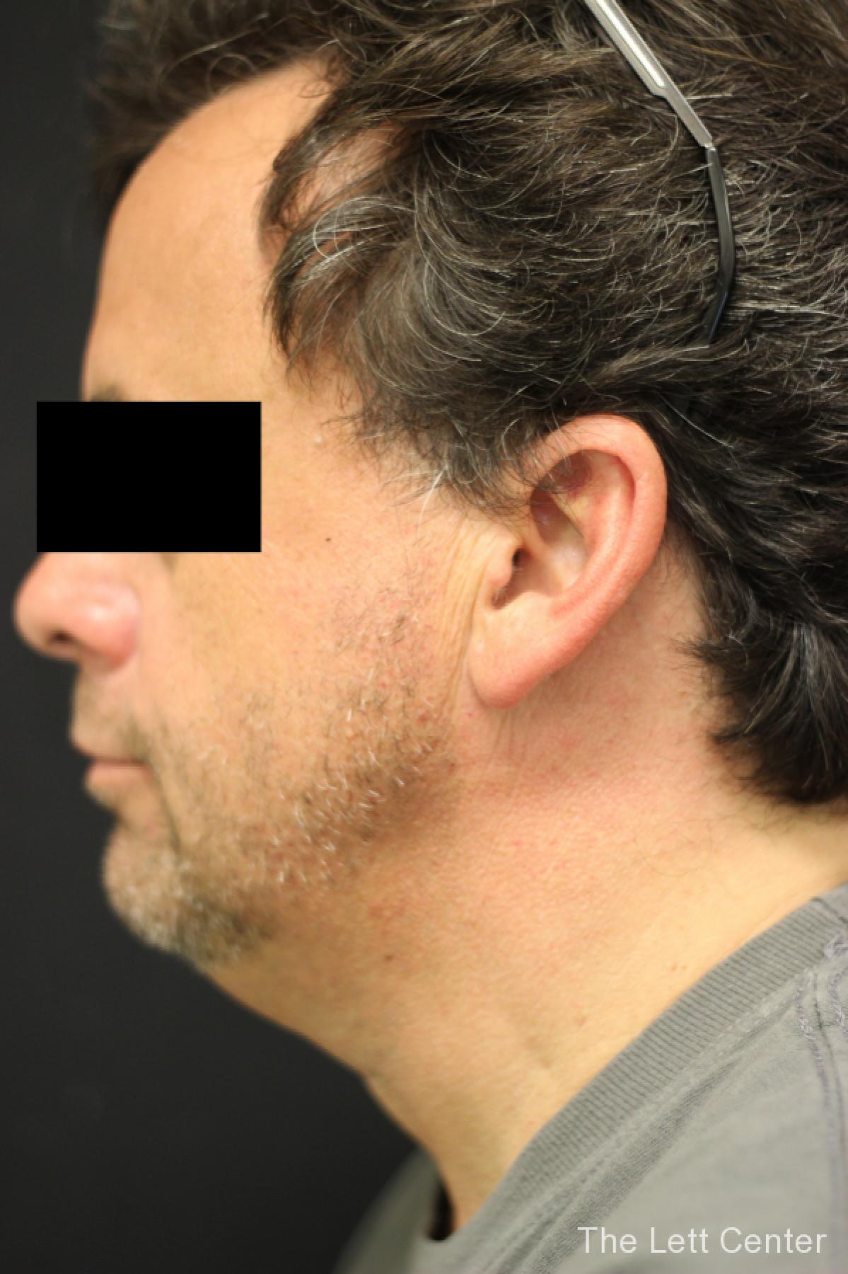 CoolSculpting for Men in Lebanon, TN | Schedule a Consultation Today - Before 2