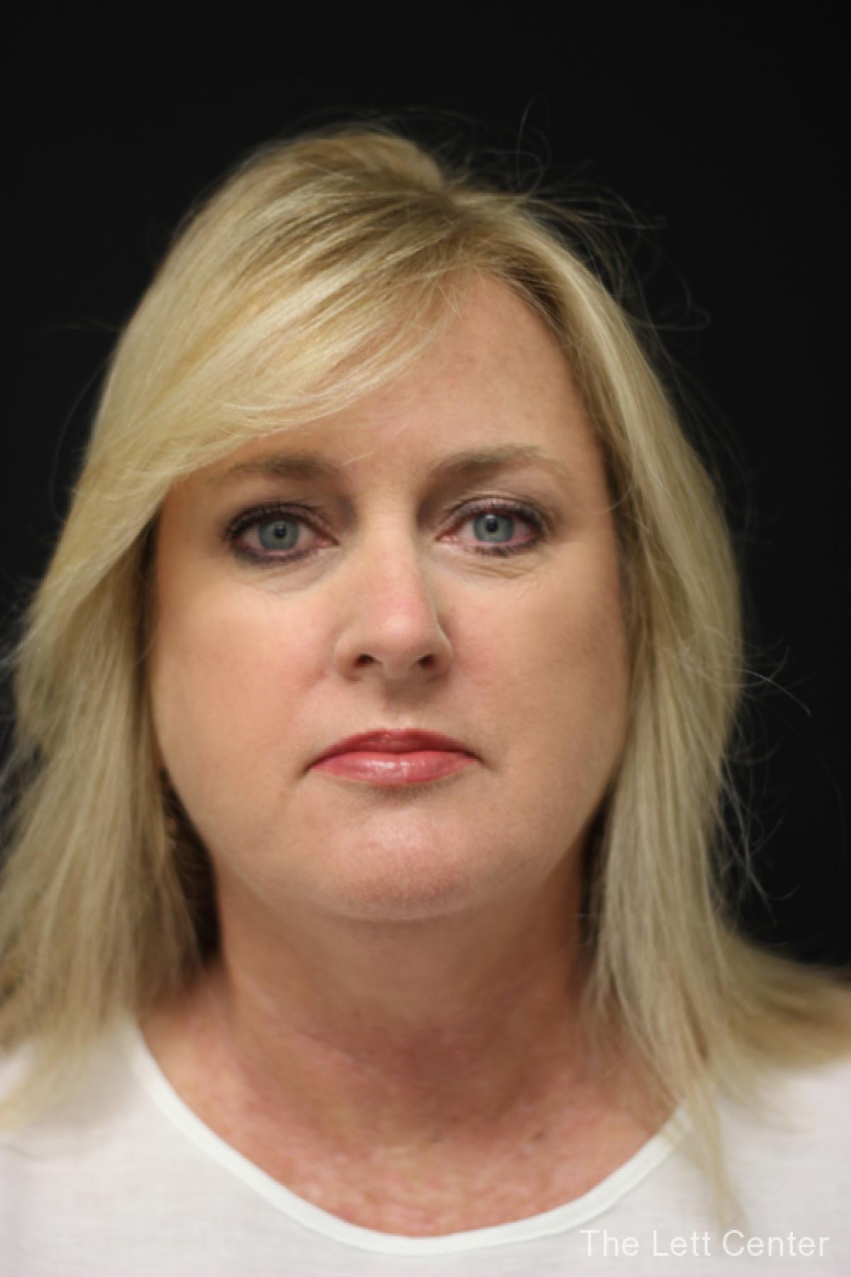 FaceTite treatments at The Lett Center in Lebanon, TN - Before 1