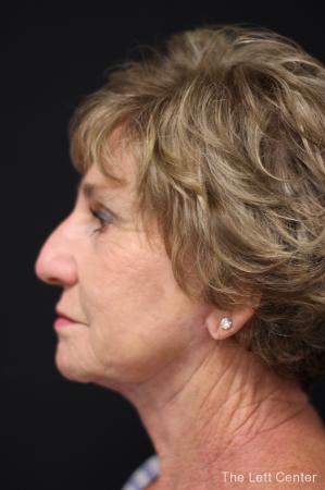 Facelift: Patient 4 - After Image 2