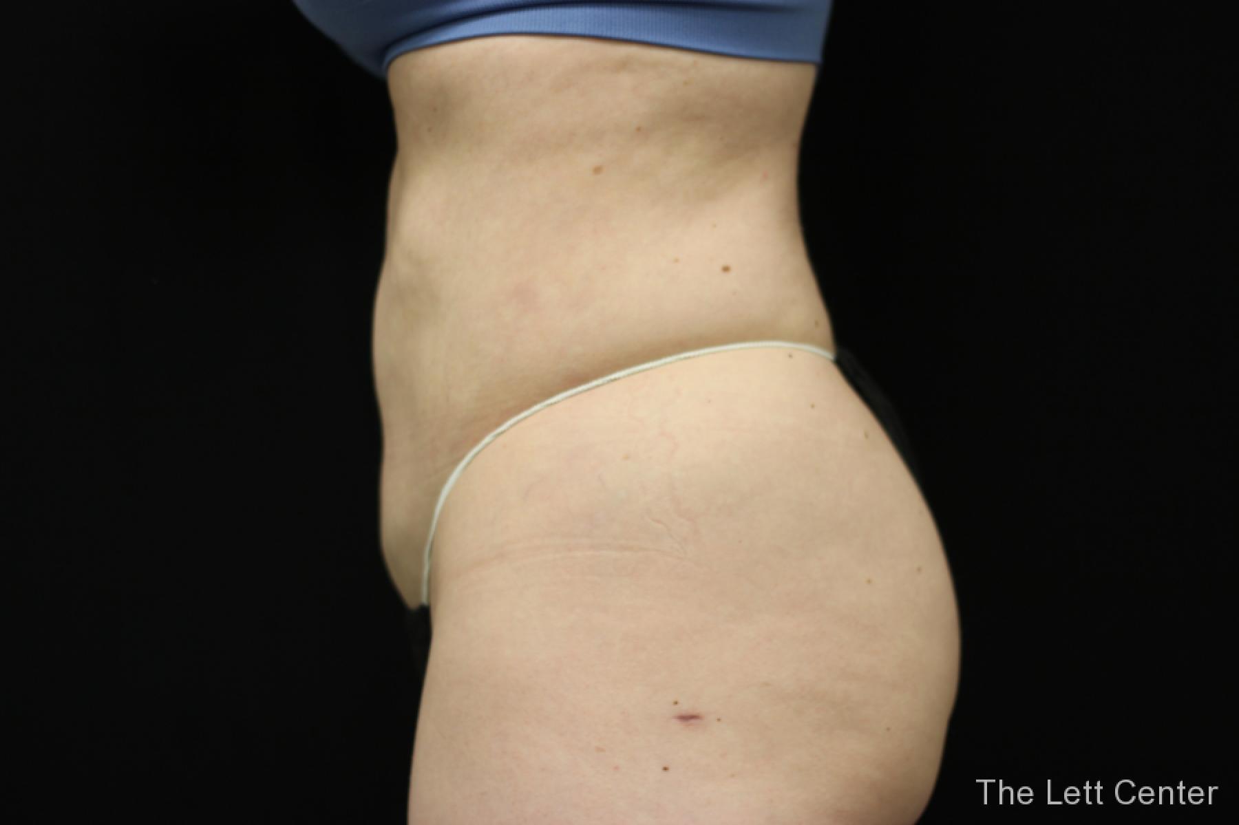 bodytite body contouring - After 2