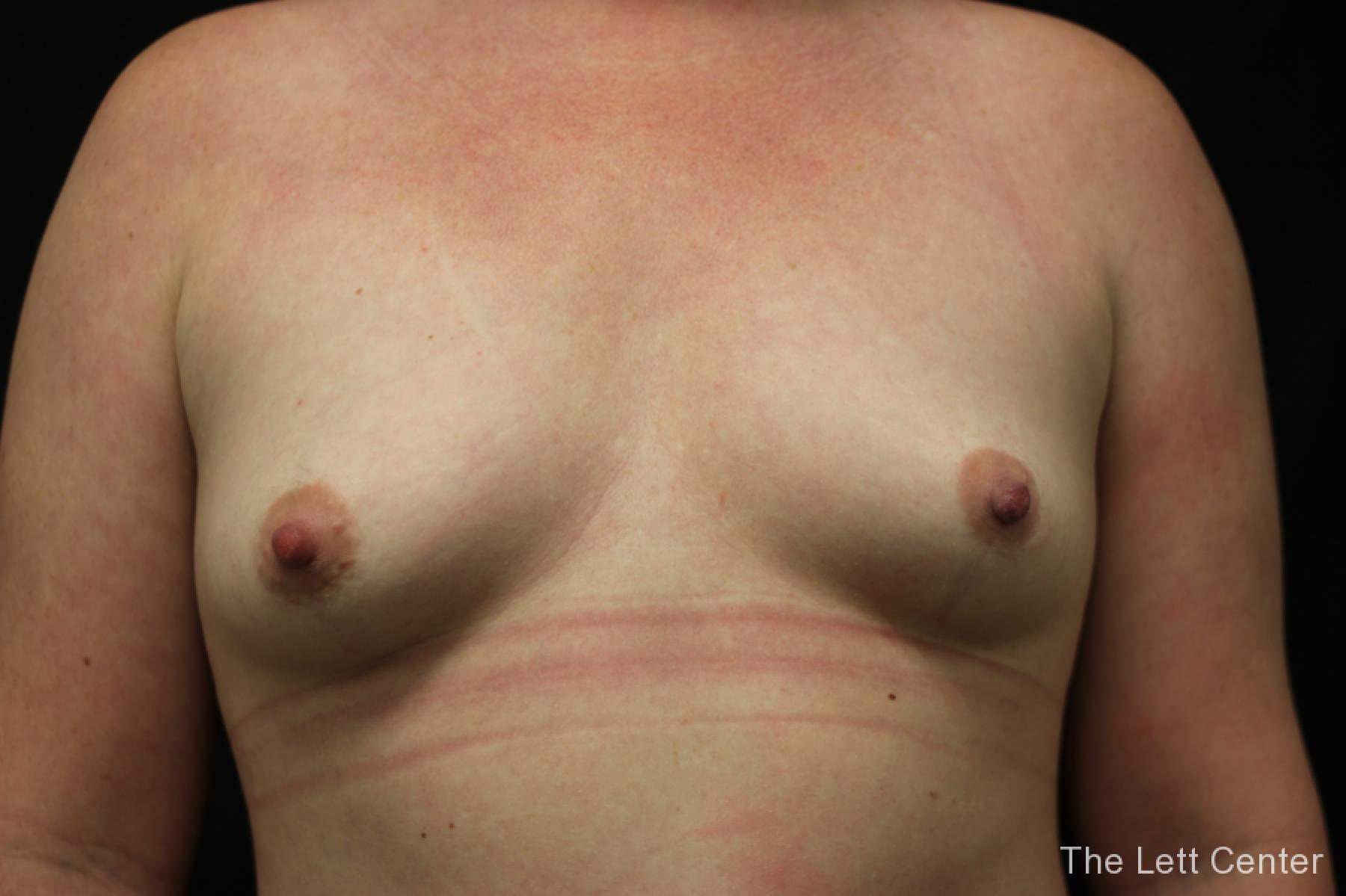 breast augmentation sugery results - Before
