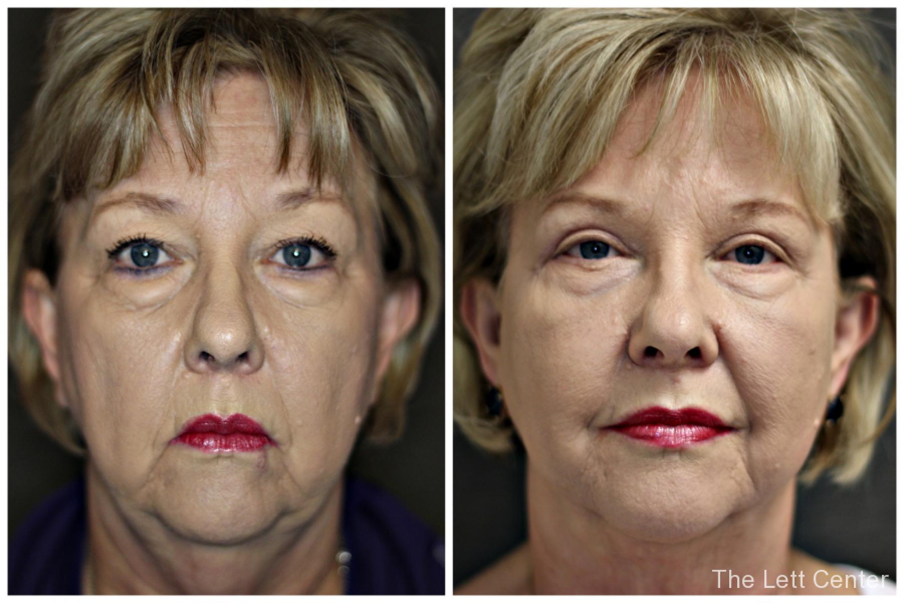 upper blepharoplasty eyelid lift and necklift plastic surgery mt juliet - Before and After