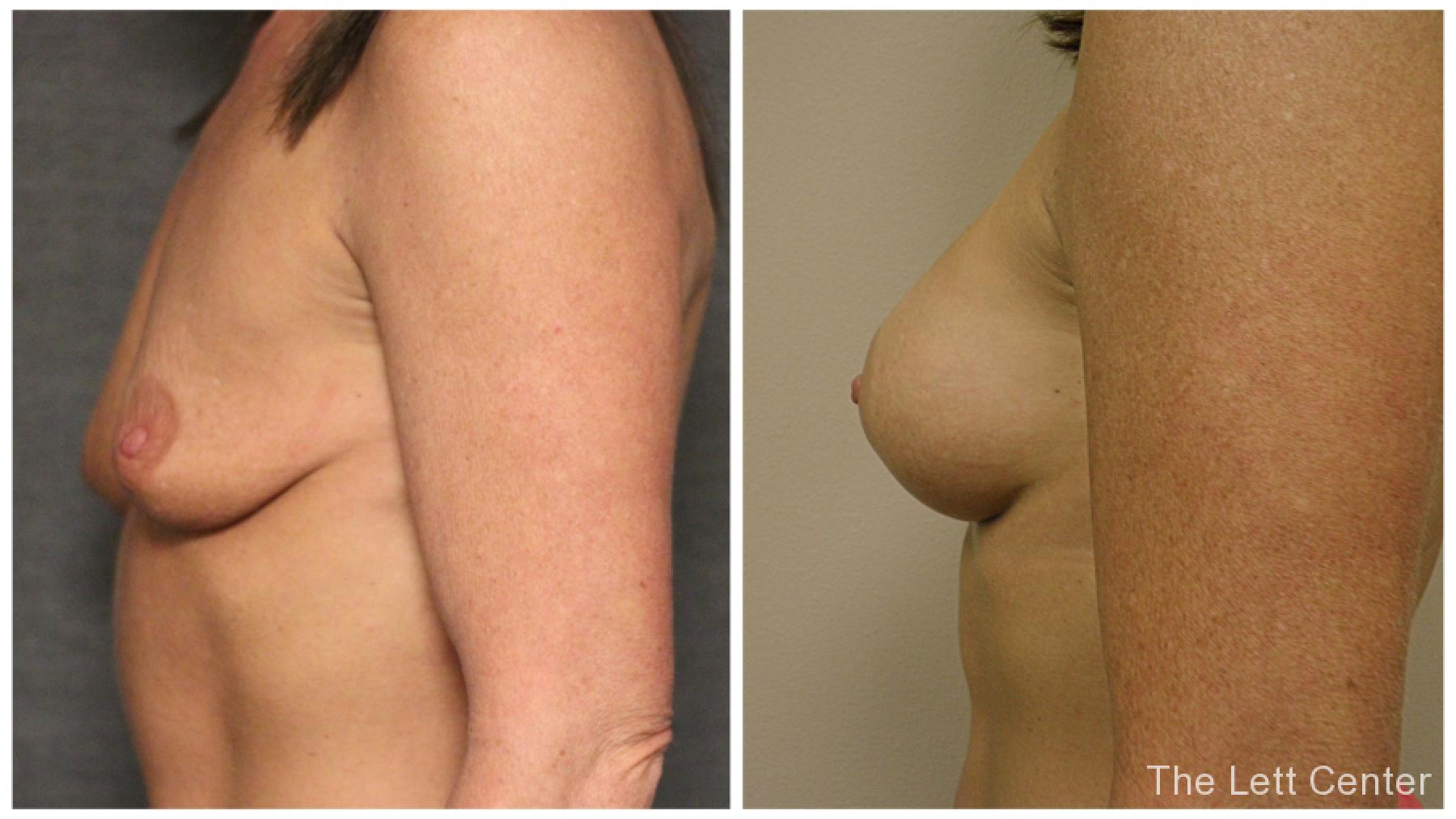 breast augmentation B&A at the lett center in lebanon and the lett center in mt juliet 10 side view - Before and After 1