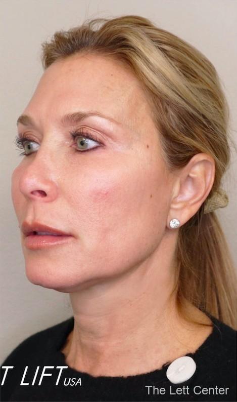 nonsurgical neck lift pdo threads mt juliet and lebanon tn - Before