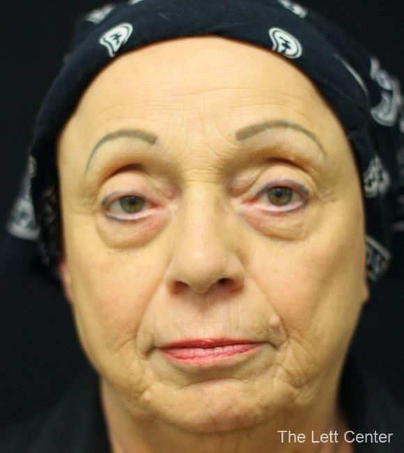 FaceTite with Lower Blepharoplasty - Before 1
