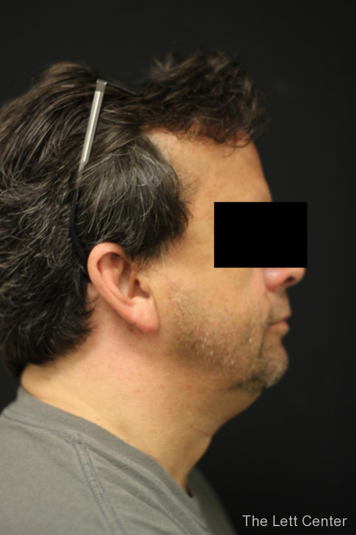 CoolSculpting for Men in Lebanon, TN | Schedule a Consultation Today - Before and After 3