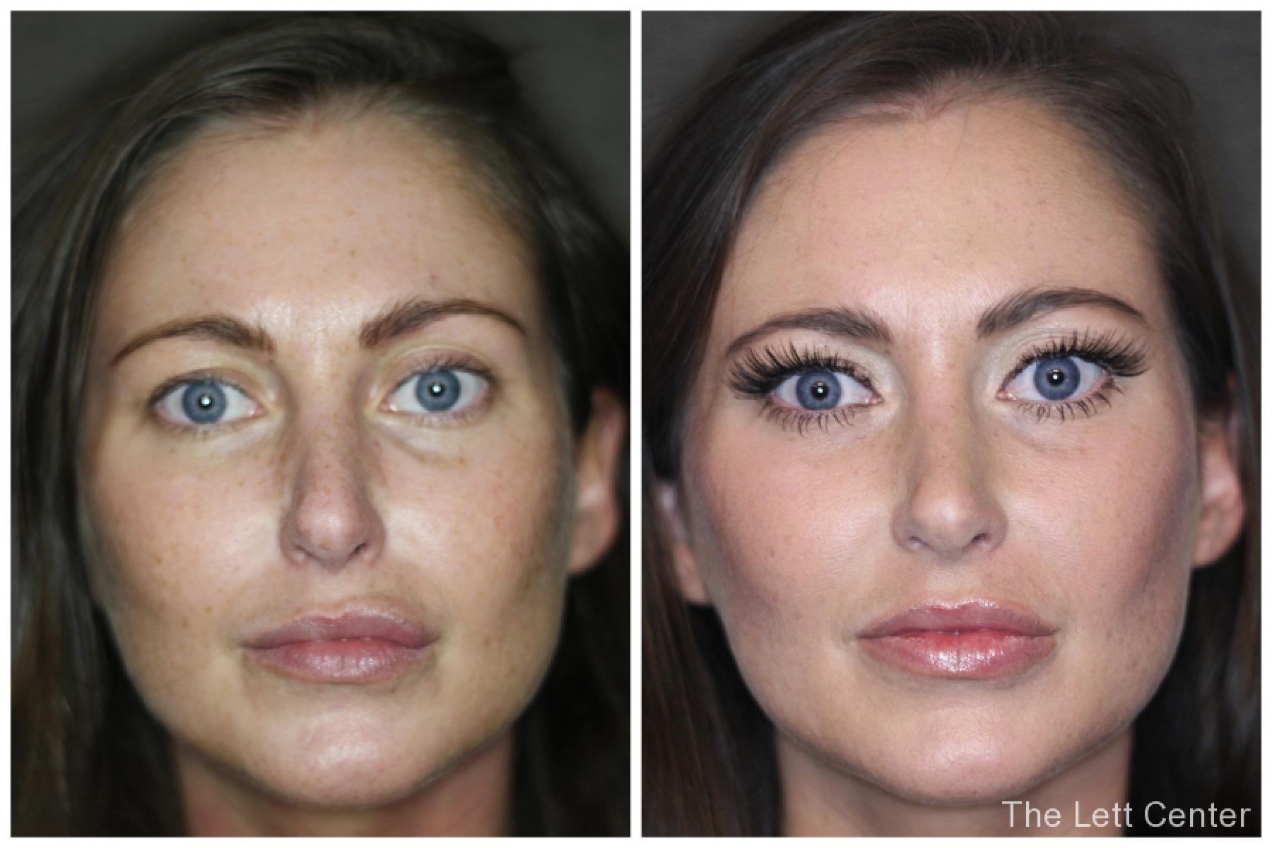 fillers for lips and cheeks in mt juliet and lebanon tn at the lett center - Before and After