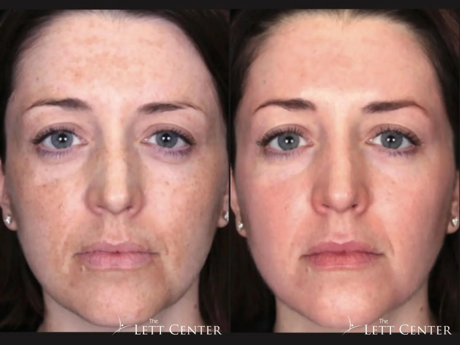 Brighten Peel: Patient 1 - Before and After