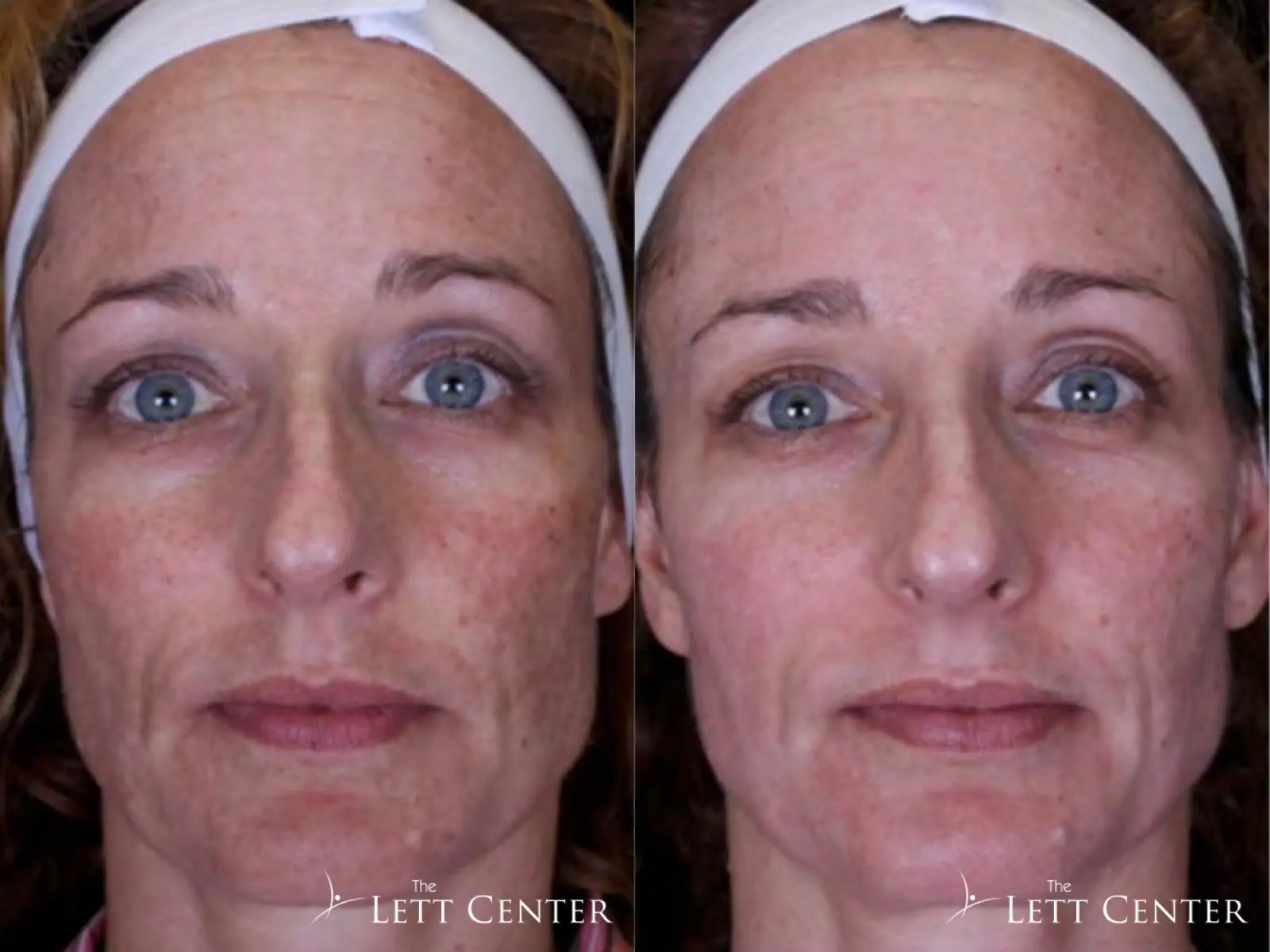 Brighten Peel: Patient 2 - Before and After