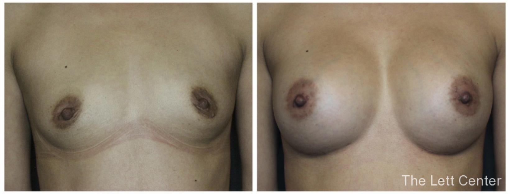 breast augmentation before and after at the lett center lebanon and the lett center mt juliet 9 front view - Before and After