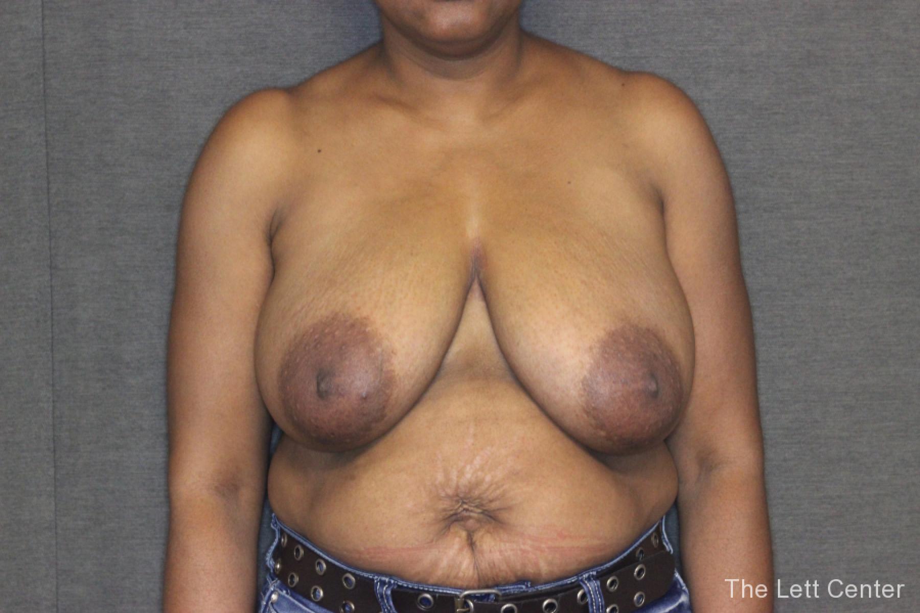 Patient 2 Results from Breast Reduction Surgery at The Lett Center - Before