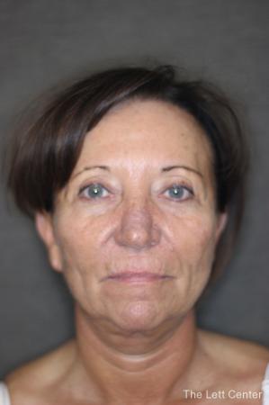 Facelift: Patient 2 - Before and After Image 4