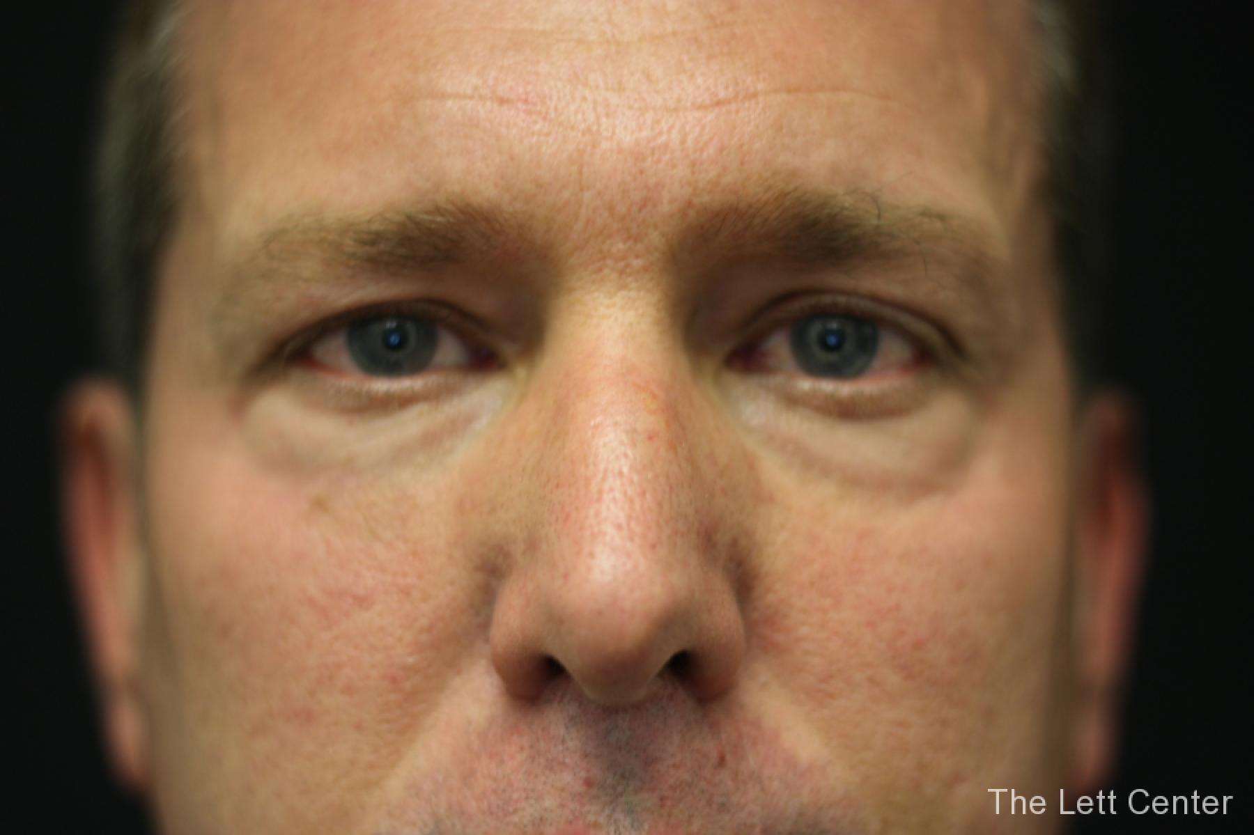 male blepharoplasty - Before and After 5