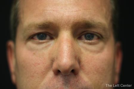 Blepharoplasty: Patient 3 - Before and After Image 5