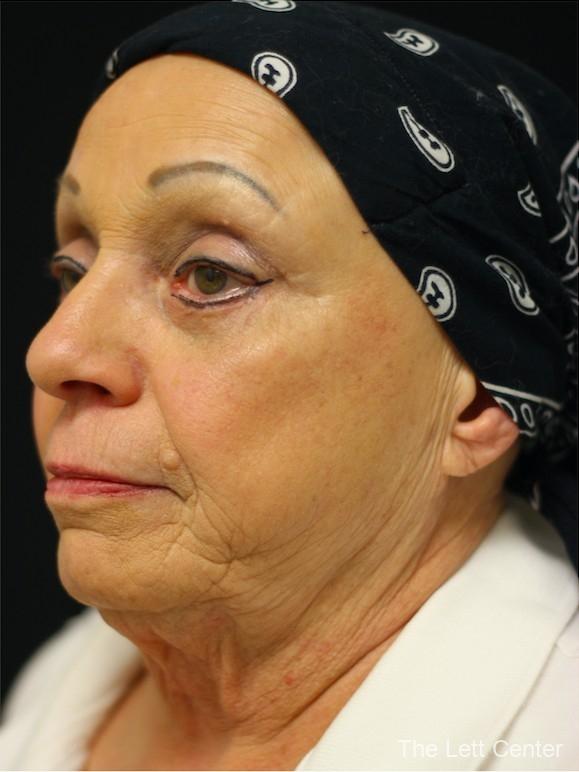 FaceTite with Lower Blepharoplasty -  After 2