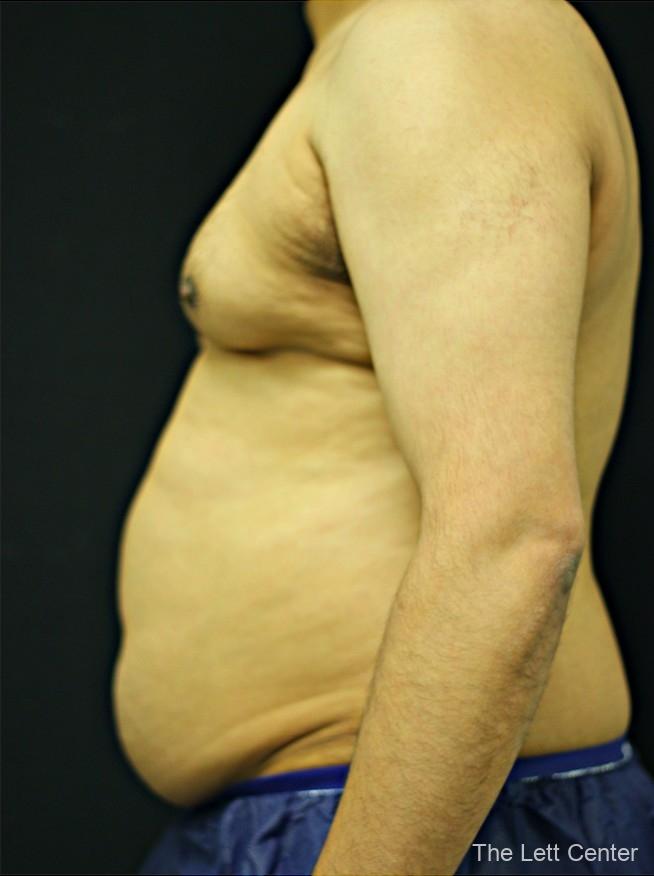 liposuction to abdomen, chest, and flanks. - Before 1