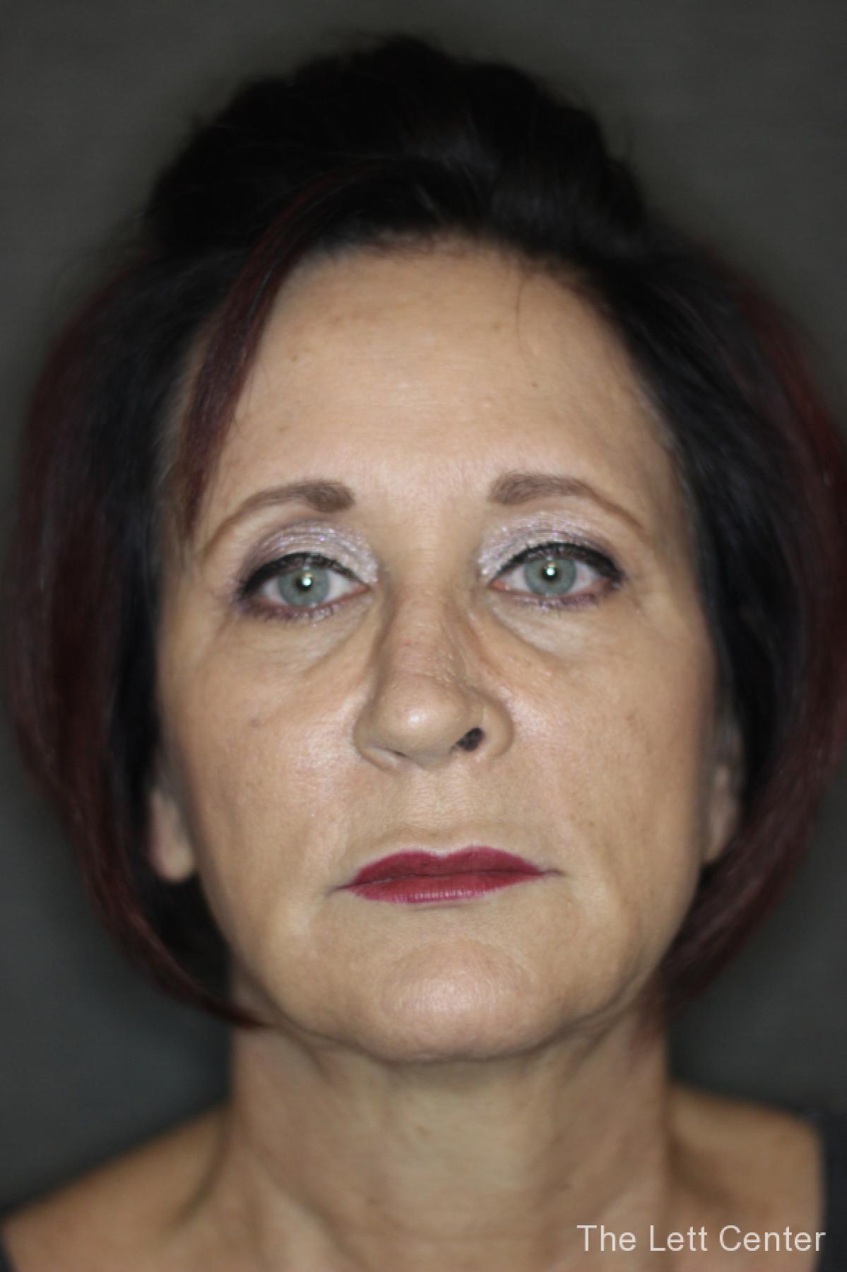 brow lift procedure - Before