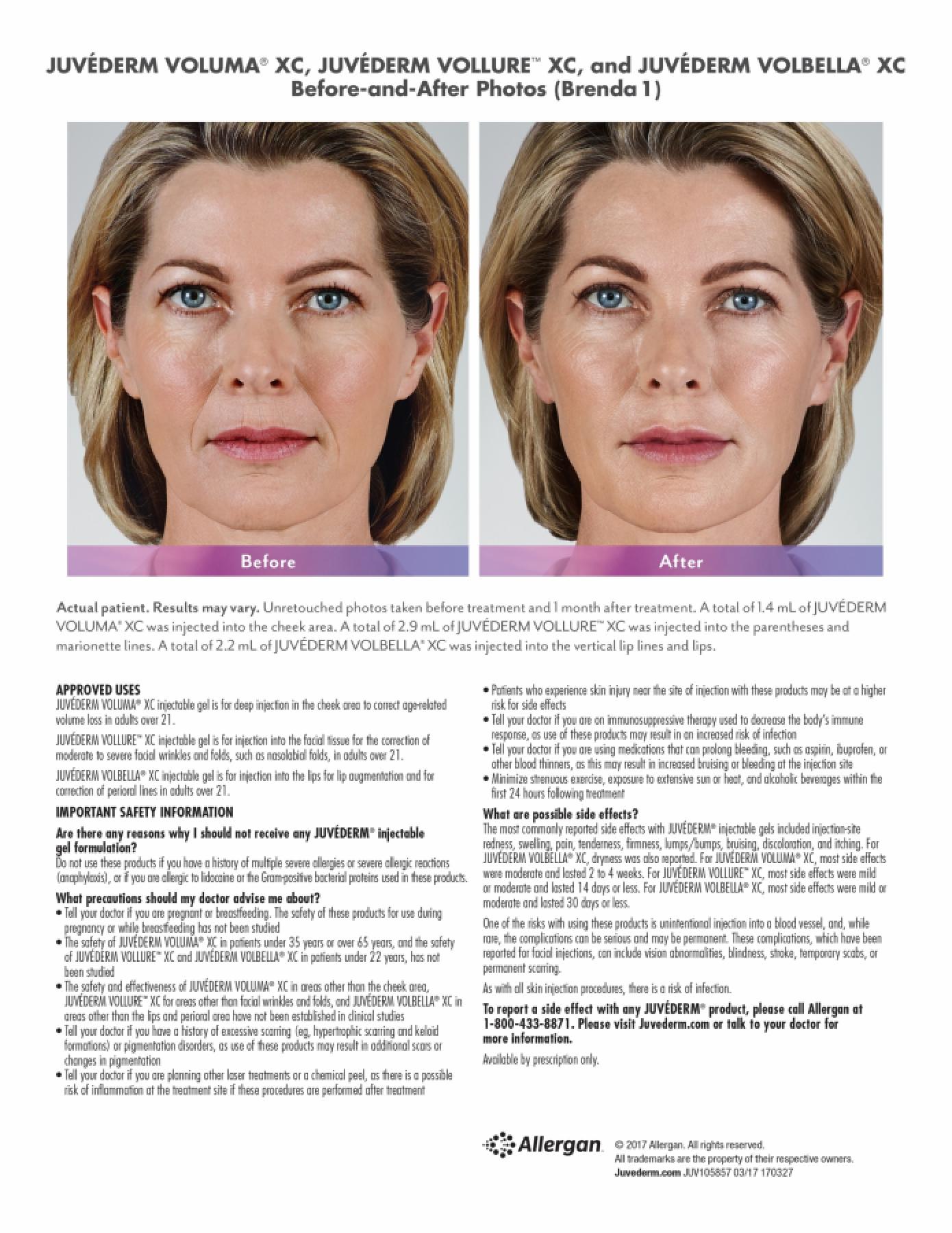 Before and After Gallery for Jevederm XC Dermafillers - Before
