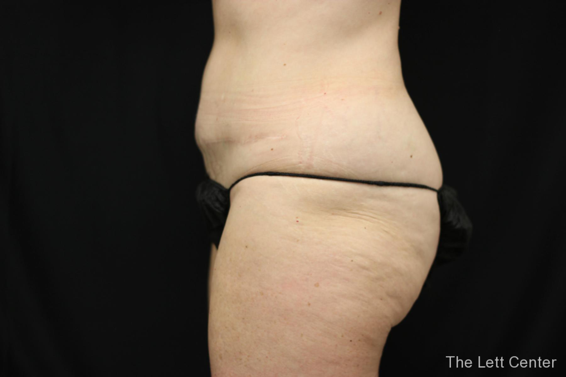 before and after results from BodyTite body sculpting - Before 2