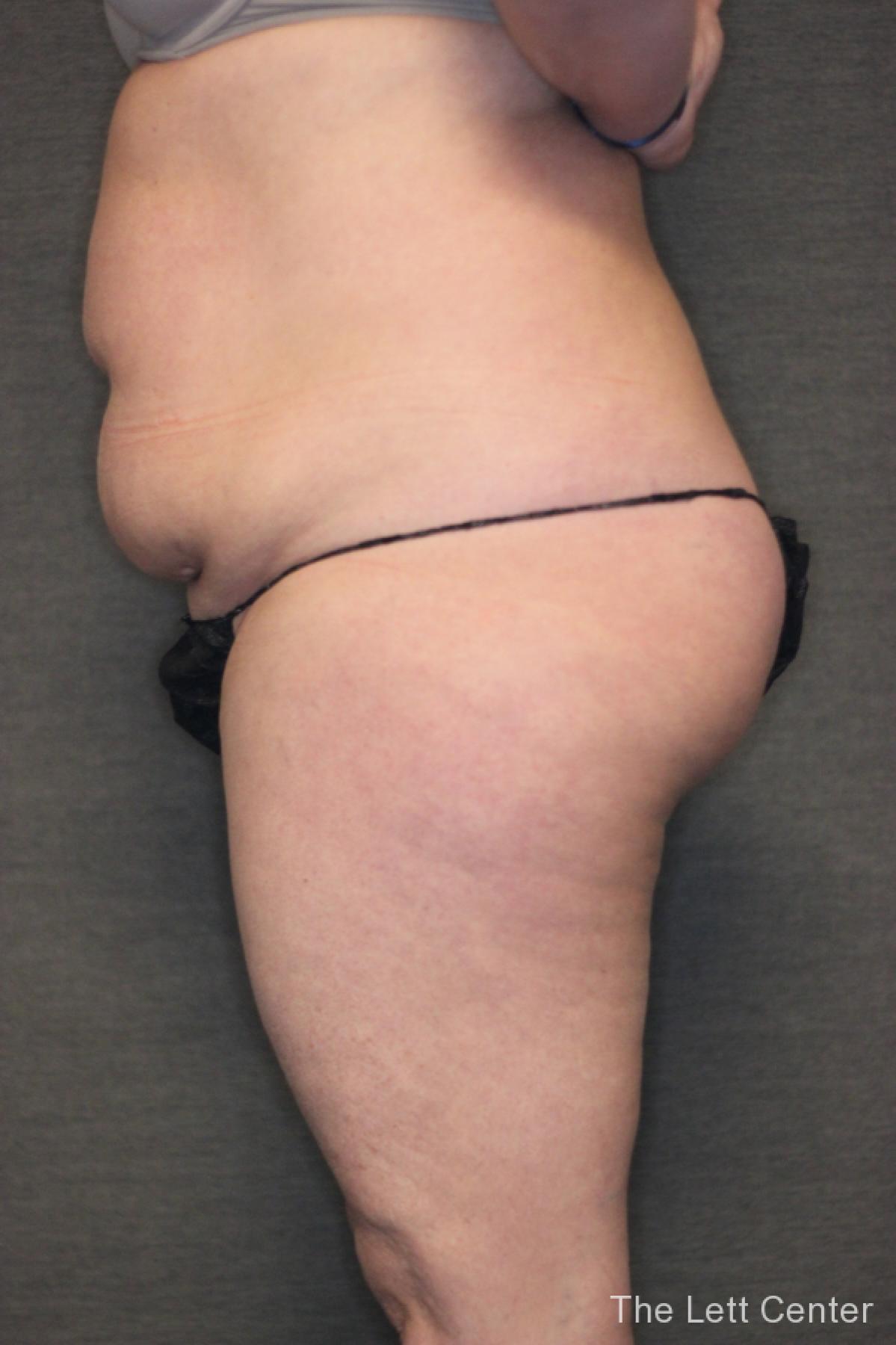 Abdominal Liposuction Results | Before After Gallery - Before 2