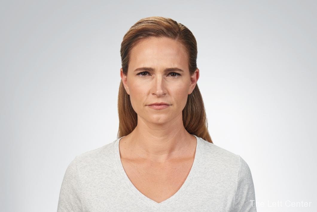 botox cosmetic injections before and after - After