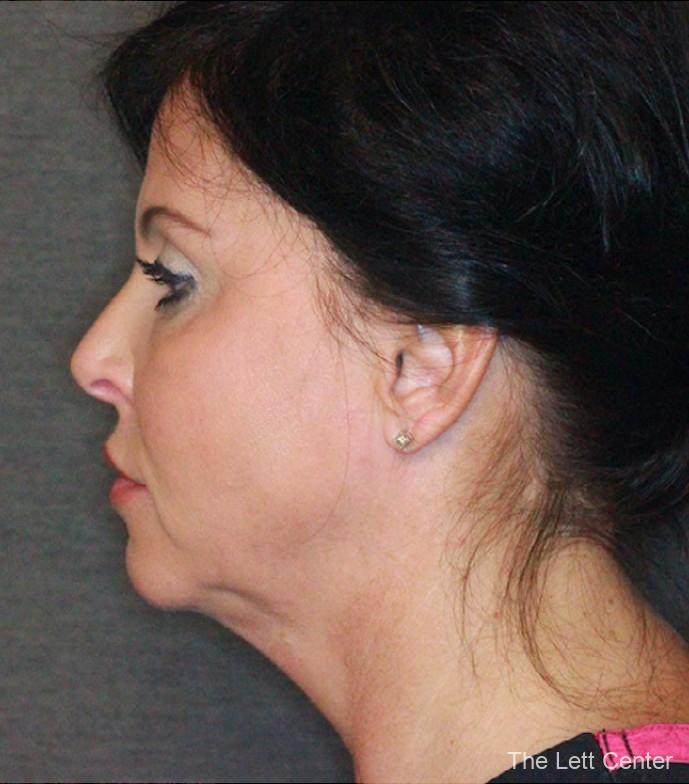 Liposuction of the neck - Before 1