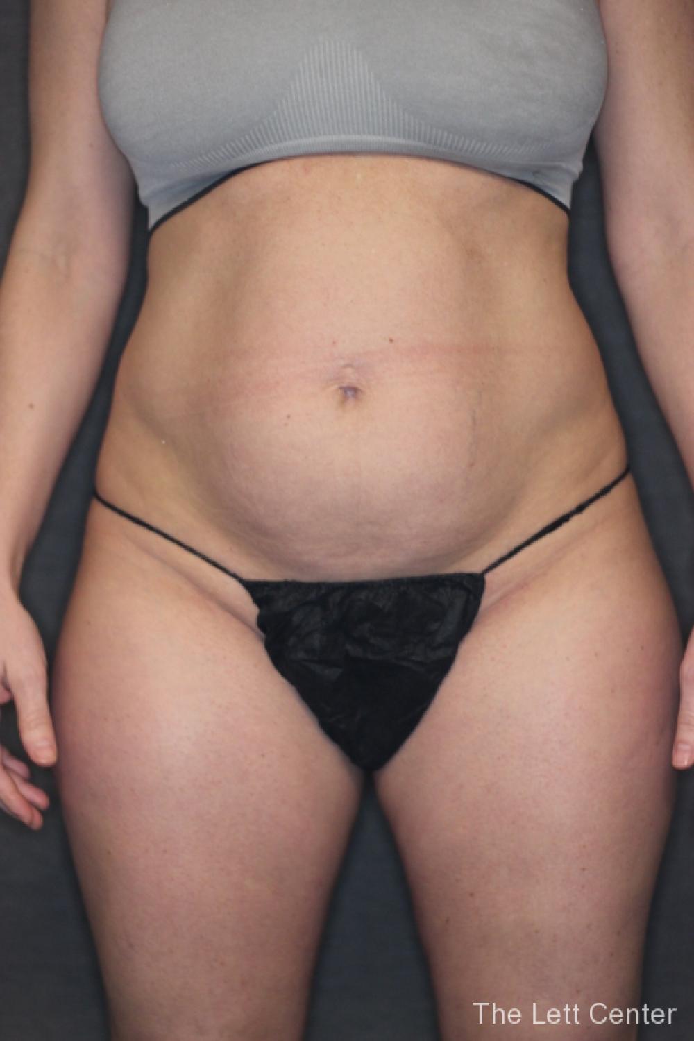 Before and after results from Liposuction at The Lett Center in Lebanon, TN - Before 1