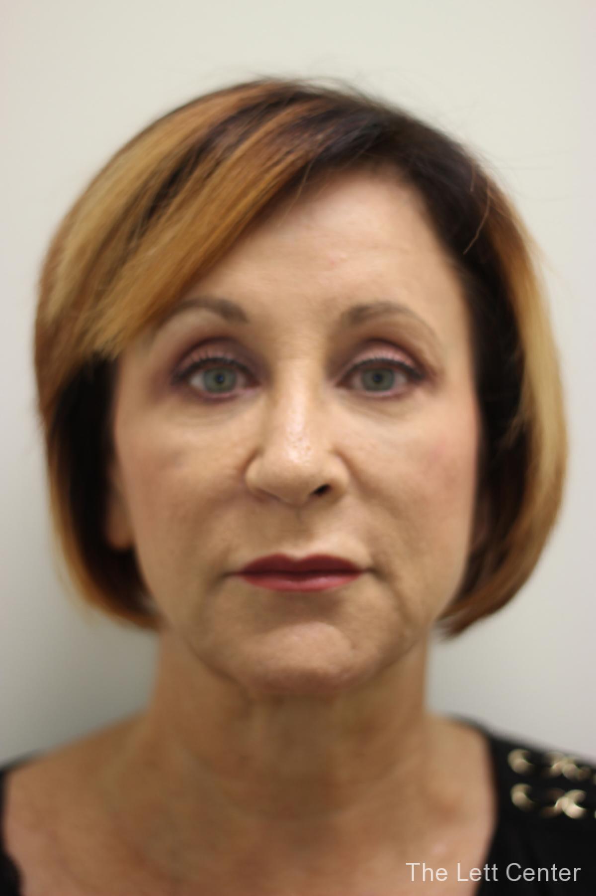 brow lift procedure - After