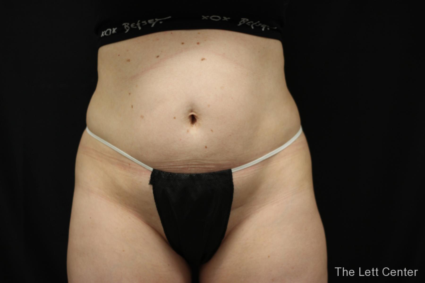 bodytite body contouring - Before 1