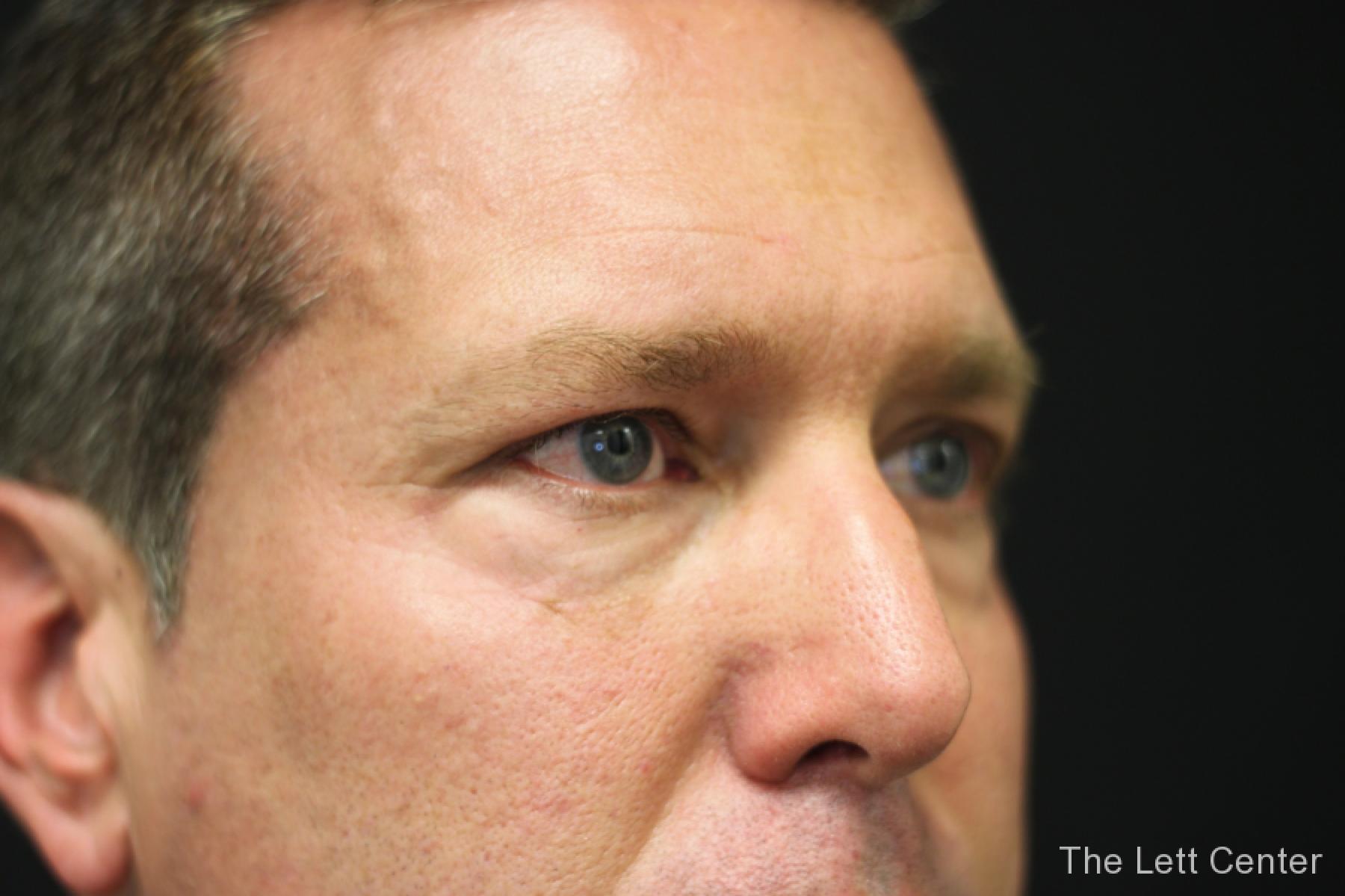 male blepharoplasty - Before 3