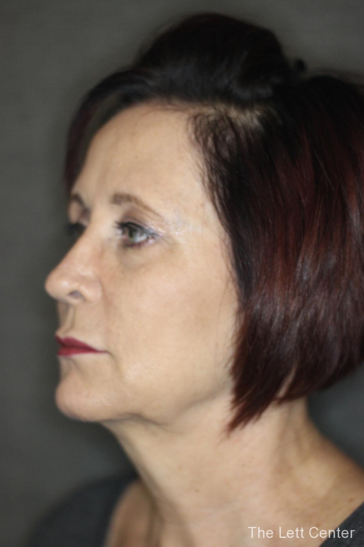 brow lift procedure - Before 2