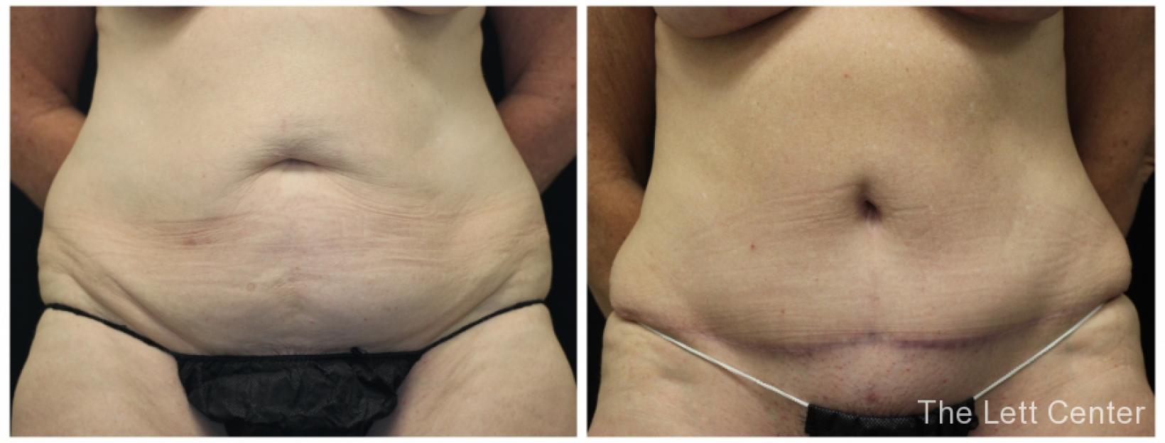 Abdominoplasty before and after results at the Lett Center - Before and After