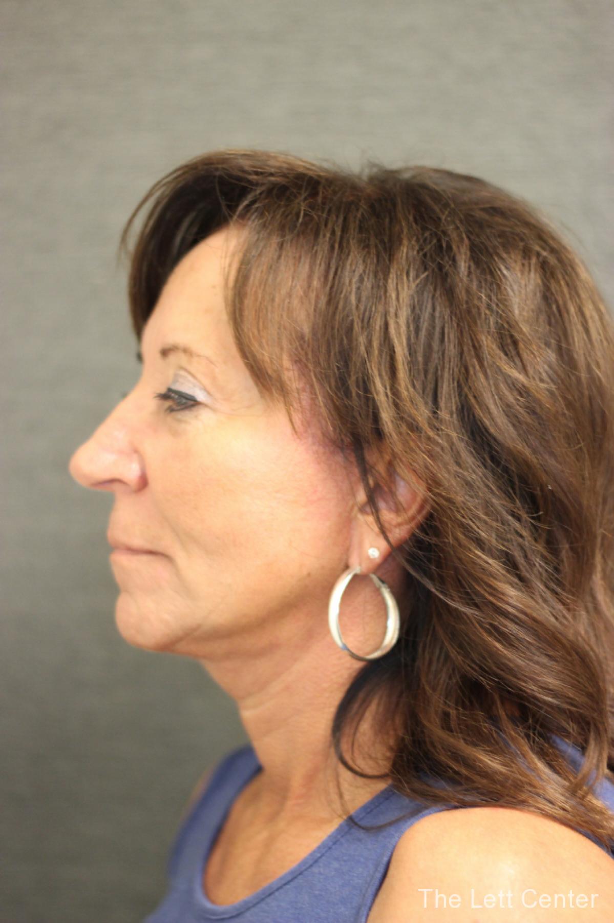 Results from Patient 2 from Facelift Surgery at The Lett Center - After 2