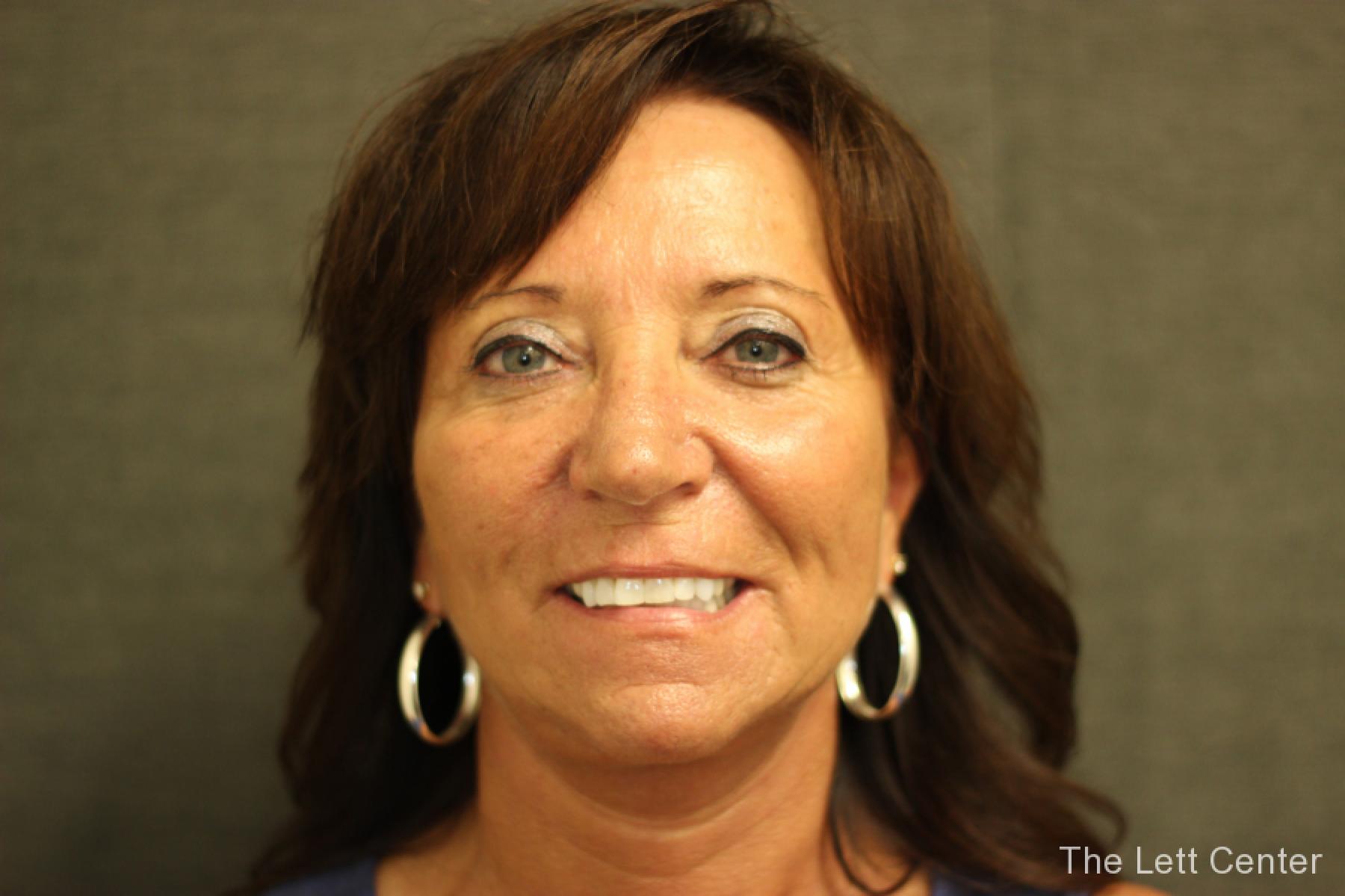 Results from Patient 2 from Facelift Surgery at The Lett Center - After 4