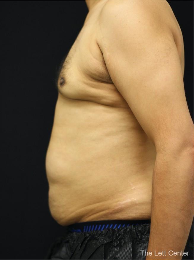 liposuction to abdomen, chest, and flanks. - After 1
