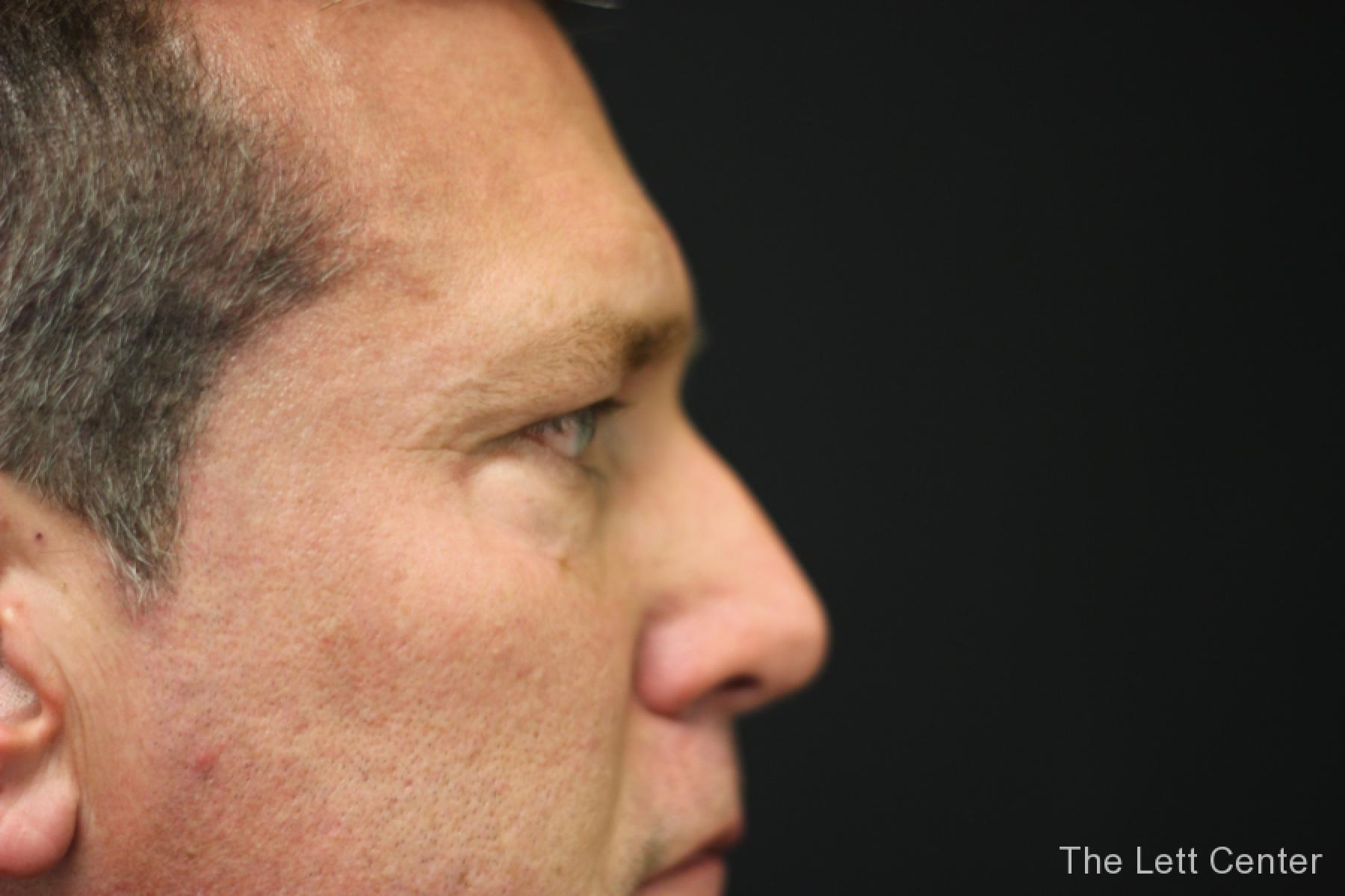 male blepharoplasty - Before 2