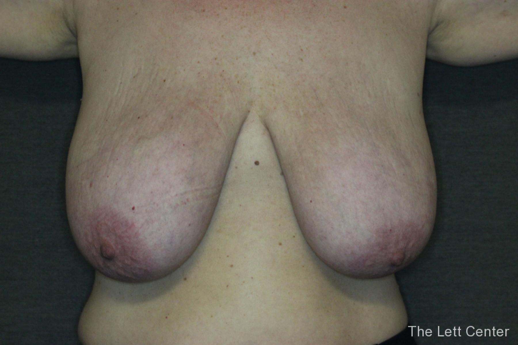 Before and After images from Breast Reduction Surgery - Before 1
