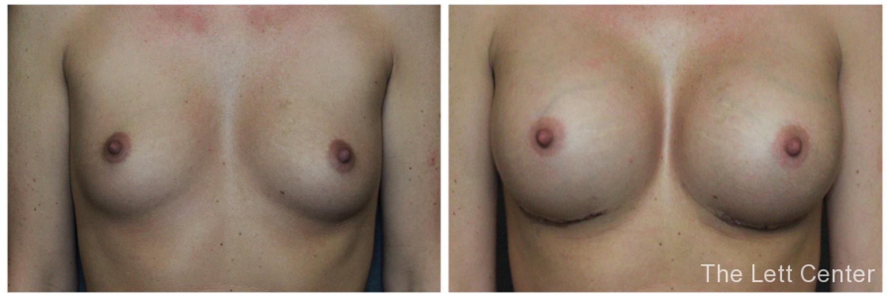 dr lett lebanon and mt juliet B&A - 1 mo post breast augmentation - Before and After