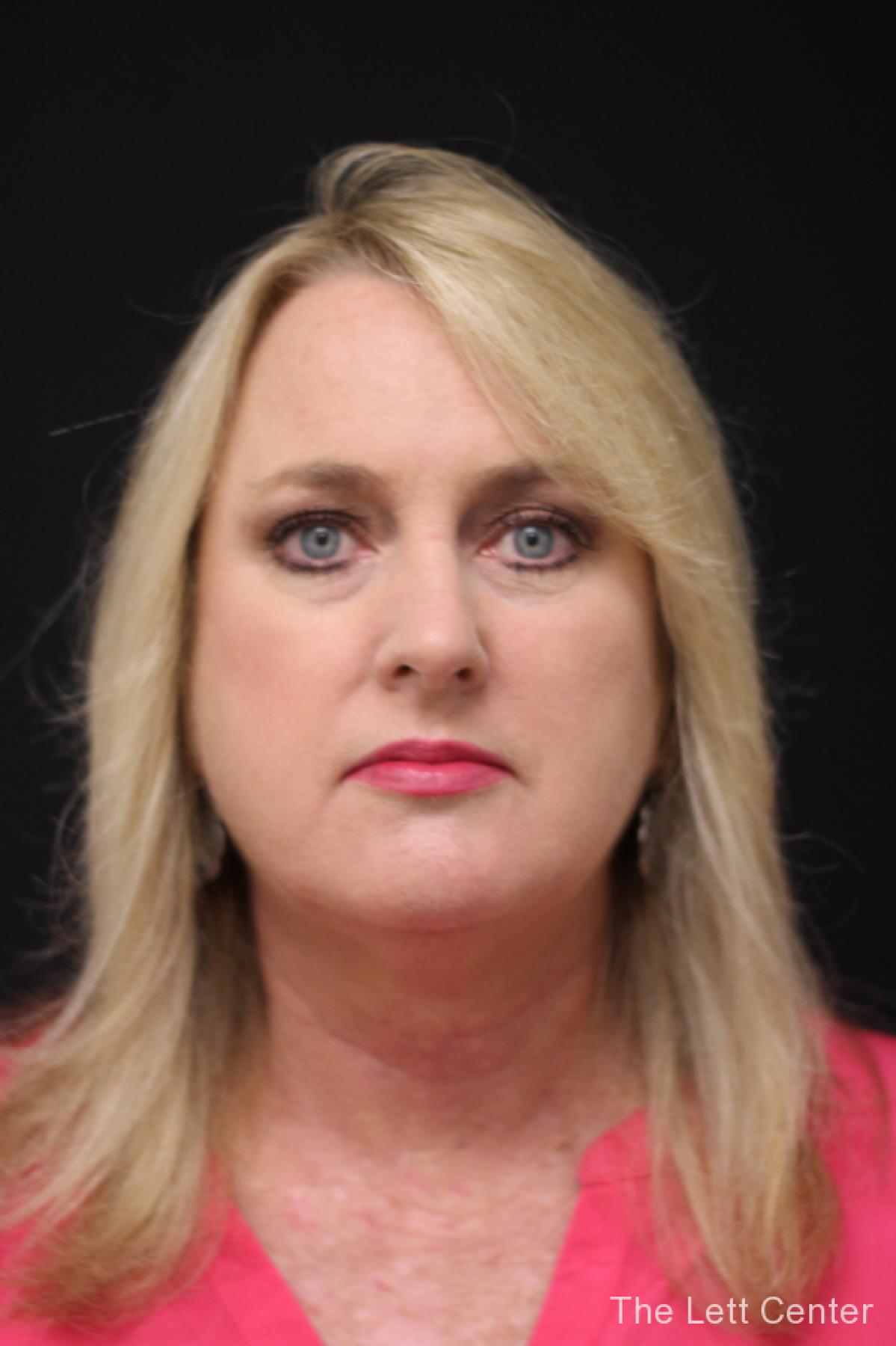 FaceTite treatments at The Lett Center in Lebanon, TN -  After 1