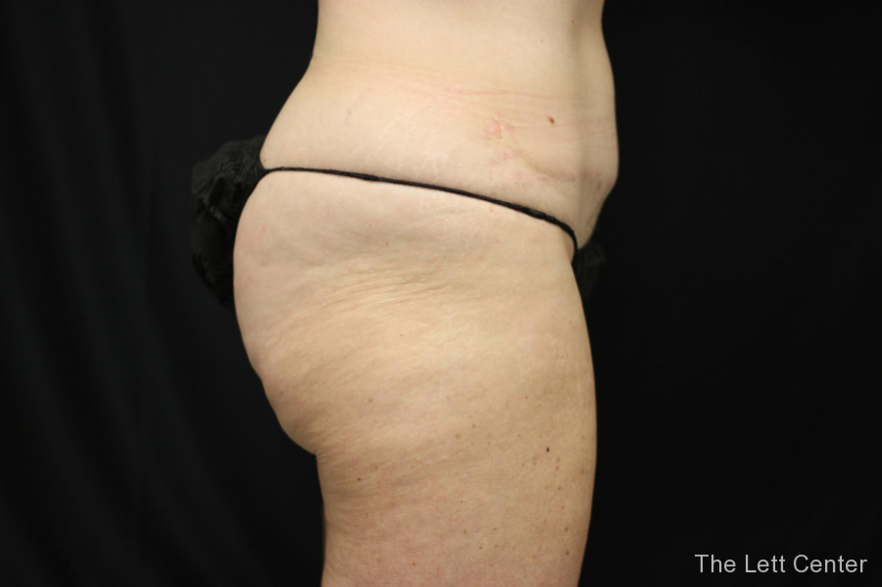 before and after results from BodyTite body sculpting - Before and After 3