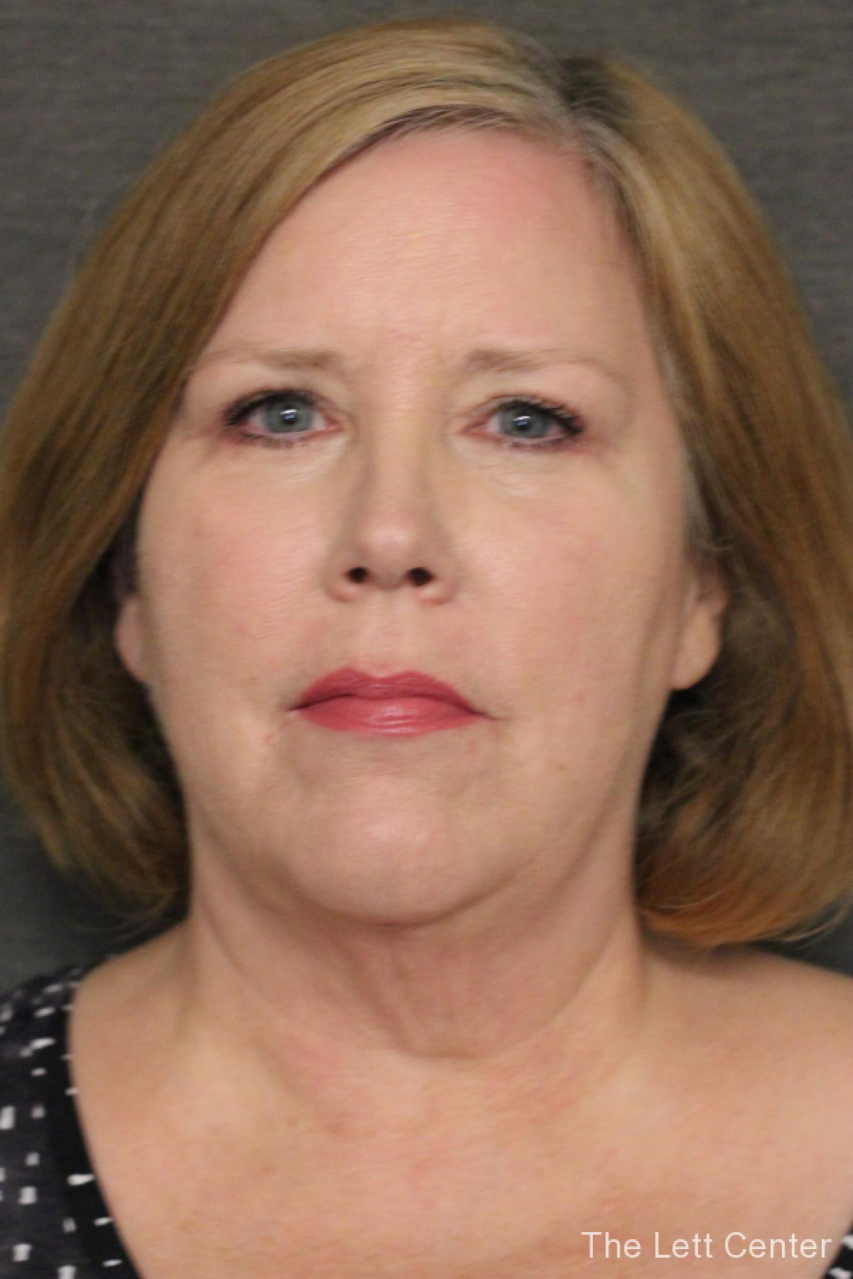 See the results from blepharoplasty or eyelid surgery - After